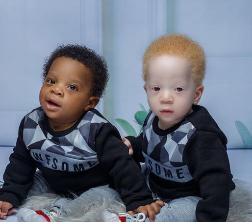 Близнаци го воодушевија светот со нивниот необичен уникатен изглед