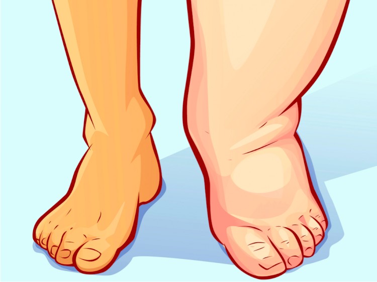 Причини за отечени нозе