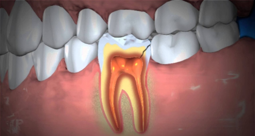 Причини за инфекција на заб