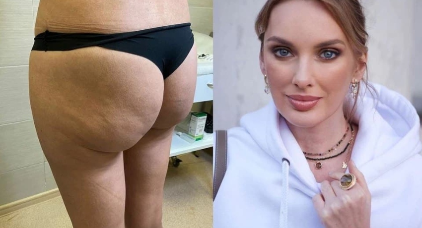 Прекрасната 45-годишна госпоѓа од Москва сакала само да си ги зголеми градите, но по анестезијата се разбудила со позадина како Кардашијан