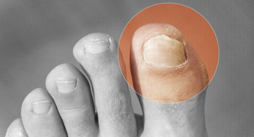 Причини за инфекција на нокт