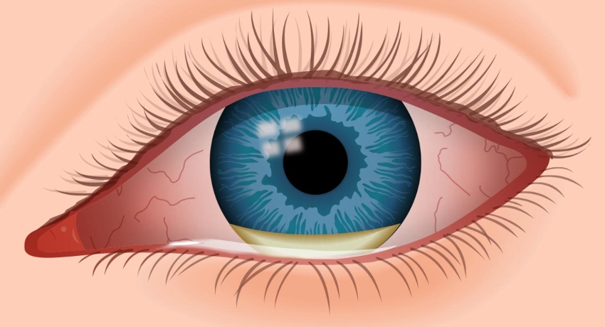 Причини за инфекција на око