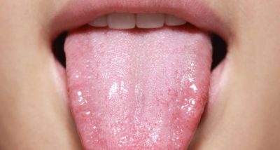 Проблем со јазикот: Кои причини се кријат зад најчестите симптоми и кога да посетите лекар